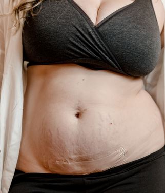 Woman showing bandage applied from the Motif Medical C Section Bandage System Stages 1,2,3